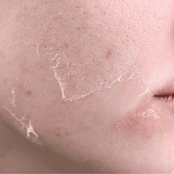 หน้าลอก