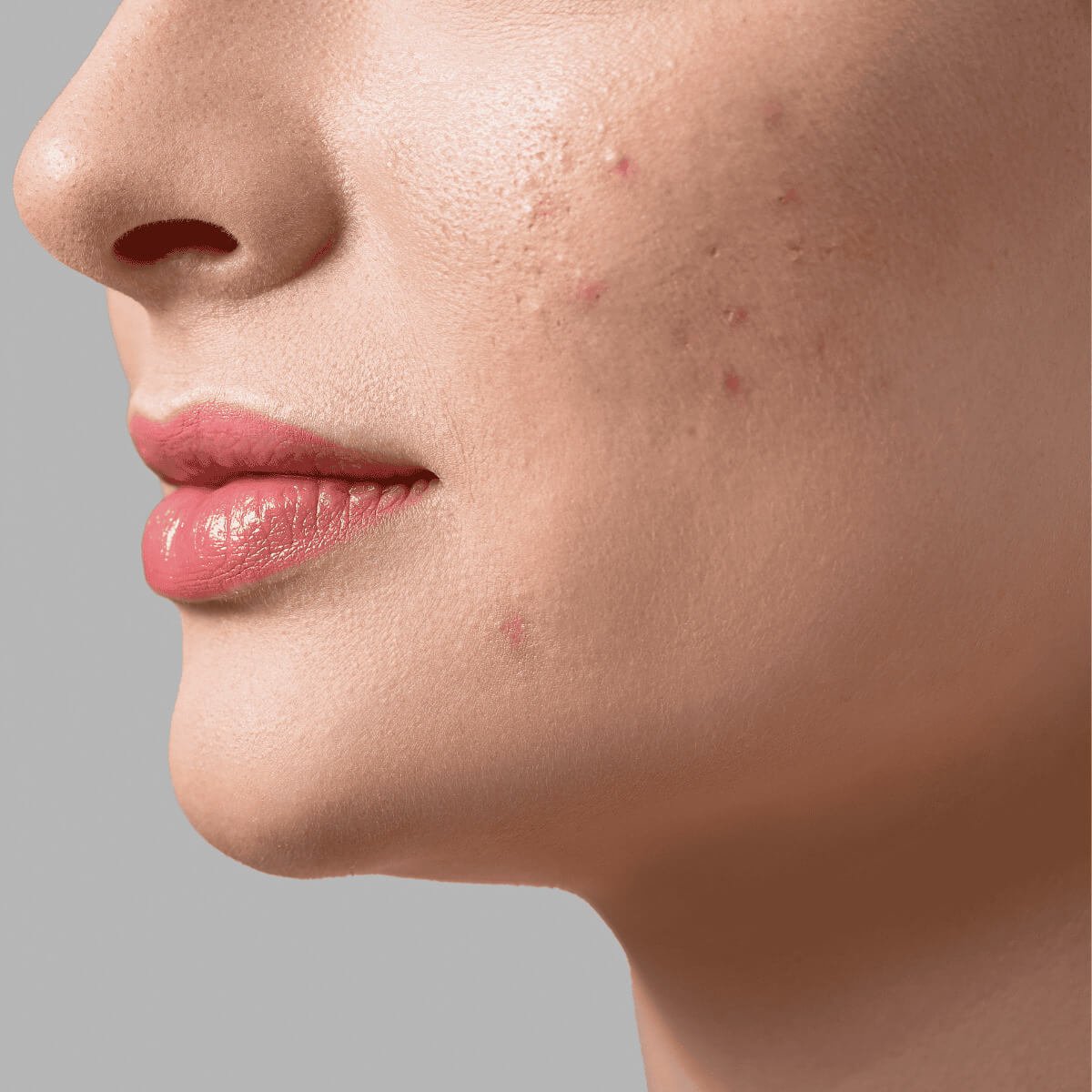 สิวอุดตัน