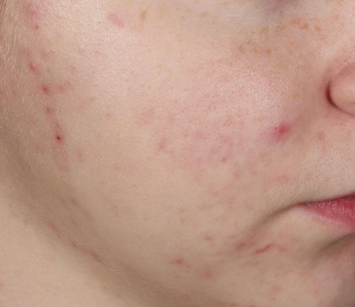 สิวผด รักษายังไงให้เห็นผล