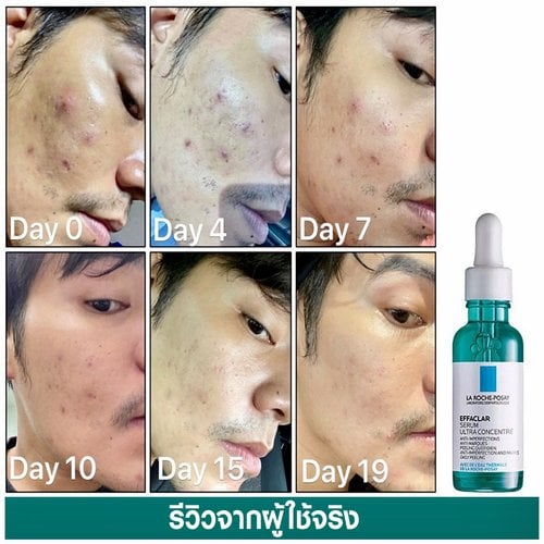 เซรั่มสลายสิวอุดตัน ที่จบต้นตอปัญหาสิว