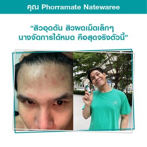 สิวอุดตันสิว สิวผดจัดการได้หมด