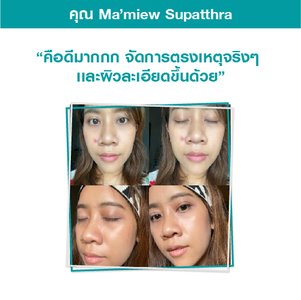 จัดการตรงเหตุ ผิวละเอียดขึ้น