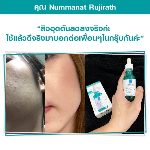 สิวอุดตันลดลง