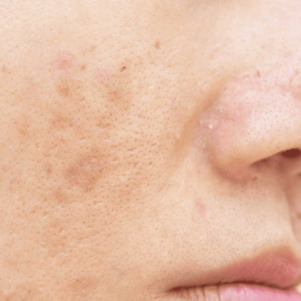 รอยสิว หายยาก