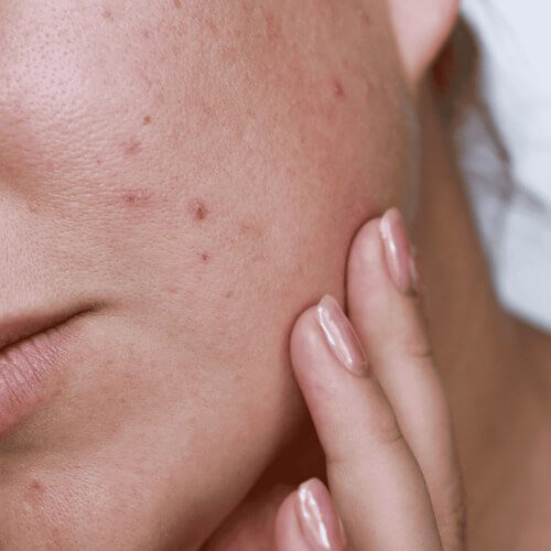 สิวอุดตัน